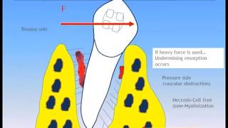 Dental Treatment: Accelerated Orthodontics Jan 31, 2017