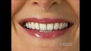 Advanced Orthodontics – IPR