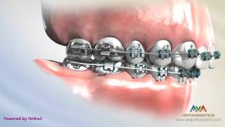 Orthodontics Treatment for Overjet (Overbite) – Headgear vs. Forsus Appliance