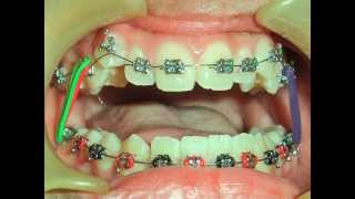 ORTHODONTIC TREATMENT NO. 12 ( Class 1 CROWDING )