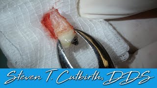 Extracting Tooth for Orthodontics – Dental Minute with Steven T. Cutbirth, DDS