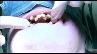 Embarrassing Bodies Dentist – Orthodontics (extreme crowding)