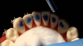 Bonding fixed permanent retainer (twistflex) in orthodontics after finishing by Dr.Amr Asker