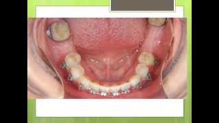 Orthodontics Treatment: Before Dental Implants