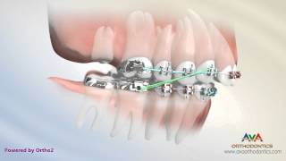 Orthodontic Treatment for Overbite (Overjet) – Removing Second Molar