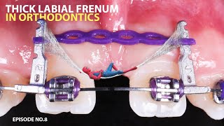 Thick labial frenum in relation to orthodontics , episode No.8 , quick orthodontic tips series .