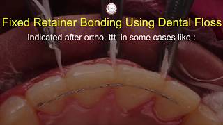 Bonding fixed permanent retainer in orthodontics with  dental floss Asker Orthodontics (twist flex)