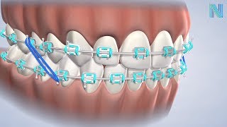 Types of Braces in Fresno CA: Dr. Nicole | Nalchajian Orthodontics