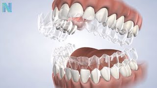 Invisalign in Fresno CA: Dr. Greg | Nalchajian Orthodontics