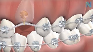 Guided Eruption of Impacted Teeth in Fresno CA: Dr. Greg | Nalchajian Orthodontics