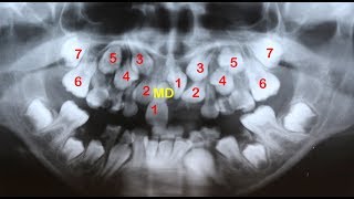 Amazing orthodontic treatment of multiple impactions