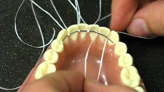 Bonded Retainer following orthodontics treatment