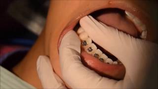 A Quick Fix For An Orthodontic Emergency At Legler Orthodontics