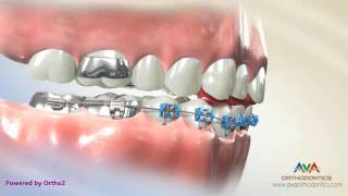 Orthodontic Treatment for Deepbite – Fixed Bite Plate on Front Teeth