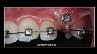 Exposure of unerupted canine using diathermy and orthodontic traction by Dr. Amr Asker