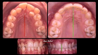 Step by step orthodontic  space opening for completely blocked lateral incisor by Dr. Amr Asker