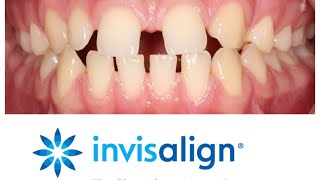 Invisalign at The Orthodontic Centre, Palmerston North