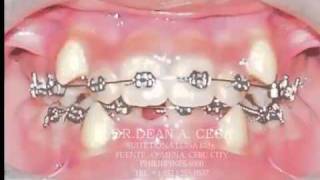 ORTHODONTIC TREATMENT 5- CROWDING- DR. DEAN A. CESA