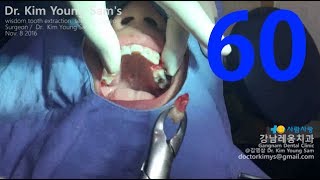 premolar extraction with forceps for orthodontic treatment