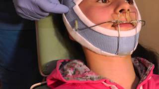 Second Stage-p3 of MewVector Orthodontic Orthotropics Headgear (Head Brace) Preparation- Dr Mike Mew