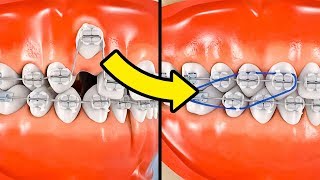 HOW BRACES WORK