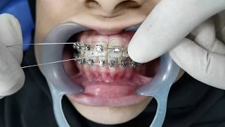 Orthodontic Ligation