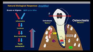 Dental Treatment: Accelerated Orthodontics Jun 6, 2019