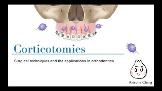 【Chris Chang Ortho】560. Corticotomies. Surgical techniques and the applications in orthodontics.