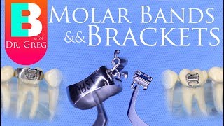 Braces Bands vs Brackets for Molars in Orthodontics