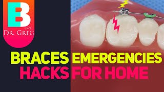 Braces Emergencies Hacks if Orthodontist Closed