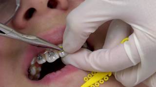 Getting Braces Installed – The First Visit – from Jacksonville University School of Orthodontics