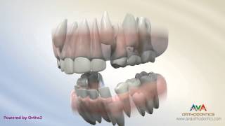 Orthodontic Treatment for Severe Crowding – Serial Extraction