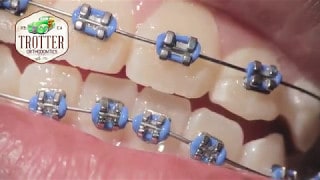 Watch How Braces Are Put On – Orthodontic Treatment Using Fixed Brackets  Redondo Beach Orthodontist