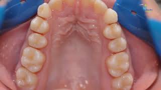 Introduction to the Banding Instruments in Orthodontics.