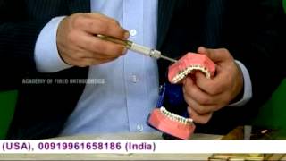 Orthodontic Mini Screw Implant (TAD) Placement Demonstration