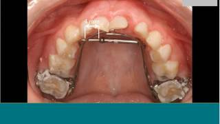 Early Orthodontic Treatment For Children, May 9, 2017