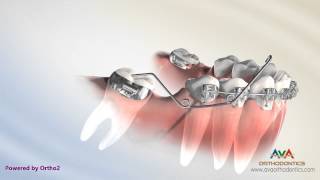 Orthodontic Treatment for Molar Uprighting – Cantilever Spring