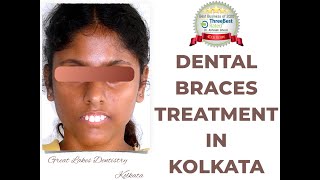 Dental Braces Procedure | Best Dental Braces Treatment in Kolkata | Orthodontic Treatment in Kolkata