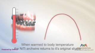 Orthodontic Wire – Nickle Titanium or NiTi