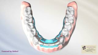 Lower Spring Aligner Resetting Lower Anterior Teeth – Wellington Village Orthodontics