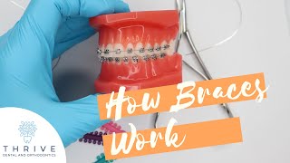 How Braces Work? | Dr. Nate | Orthodontist