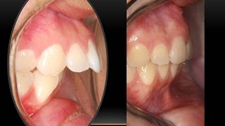 Amazing Over- jet Correction with miniscrews: Orthodontist