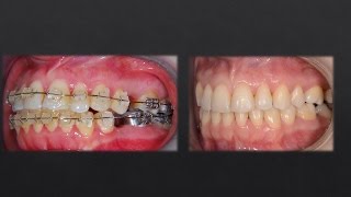 Watch How Orthodontist corrected teeth with Braces!