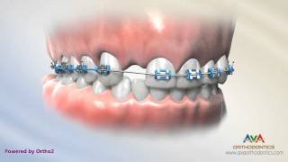 Orthodontic & Restorative Treatment for Missing Lateral Incisor – Maryland Bridge