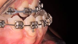 Class III  – Orthodontic surgical treatments