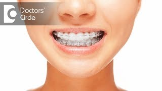 How long will it take to complete an Orthodontic Treatment? – Dr. Divyashree Rajendra