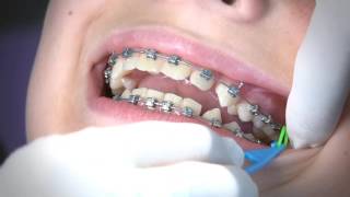 Orthodontics Limited Elastics Video