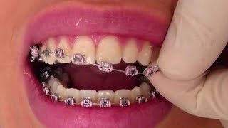 Life After Orthodontic Braces By Dr Mike Mew