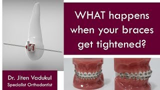 WHAT happens when your braces get tightened?  |  Dr. Jiten Vadukul  |  The Orthodontist