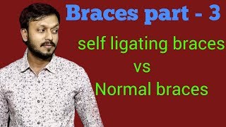 Self ligating braces vs normal braces |Damon system braces | Orthodontist | traditional braces hindi